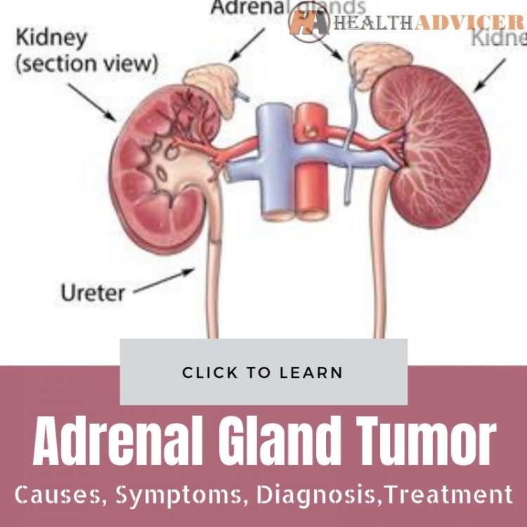 Adrenal Gland Tumor Causes, Picture, Symptoms, And Treatment