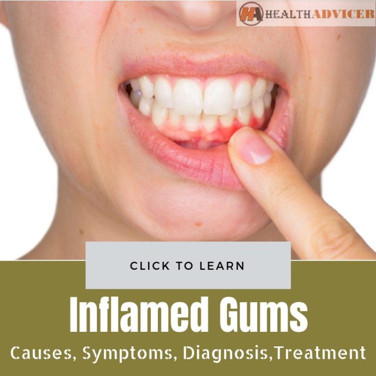 Inflamed Gums Causes, Symptoms, Diagnosis And Treatment